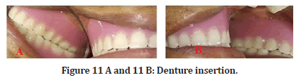 Medical-Dental-Denture