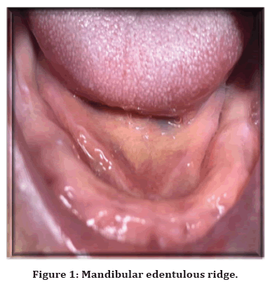 medical-dental-science-edentulous-ridge