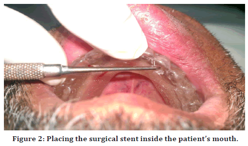 medical-dental-science-edentulous-ridge