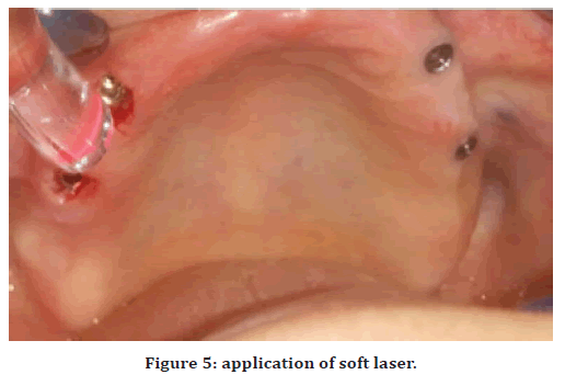 medical-dental-science-edentulous-ridge