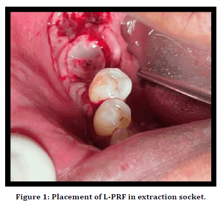 medical-dental-science-extraction-socket