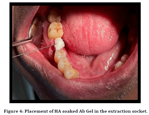 medical-dental-science-extraction-socket