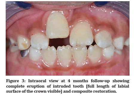 Medical-Dental-eruption